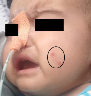 An excoriated erythematous papule (black circle) over cheek with overlying punctum.